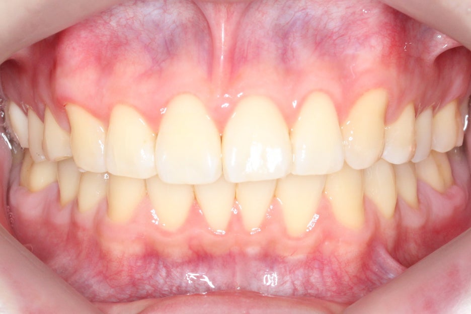 논현동치과 윗니부분교정 후기 관련 이미지 7