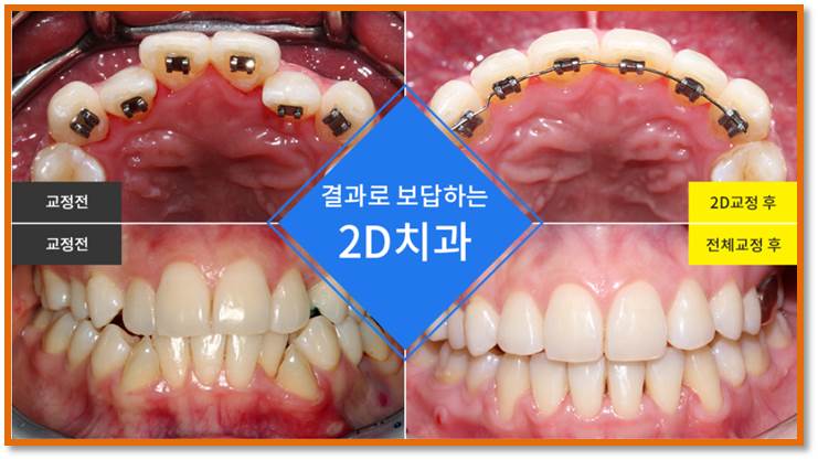 [투디(2D)치과] 2D교정 / 앞니교정 연예인들도 찾는 병원! 관련 이미지 2