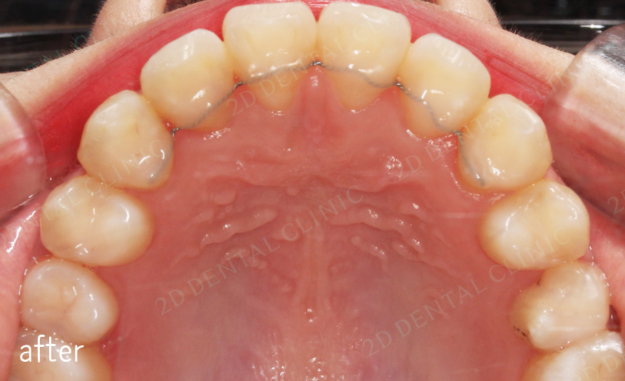 우디의 교정일기ㅣ덧니 치아교정 후기 (feat.부정교합) 관련 이미지 5