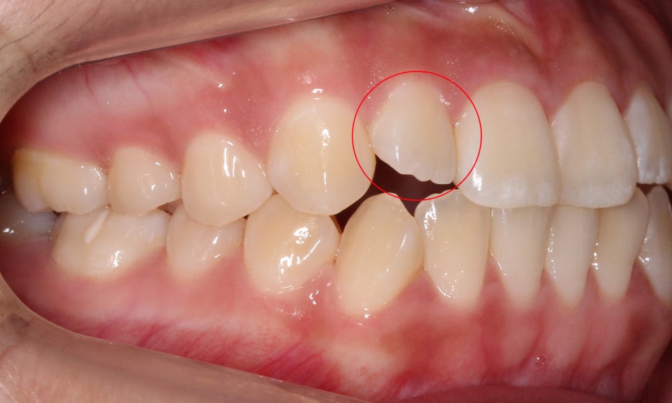 톱니모양 치아를 매끄러운 치아모양으로 개선하는 방법! (마멜론치아) 관련 이미지 2