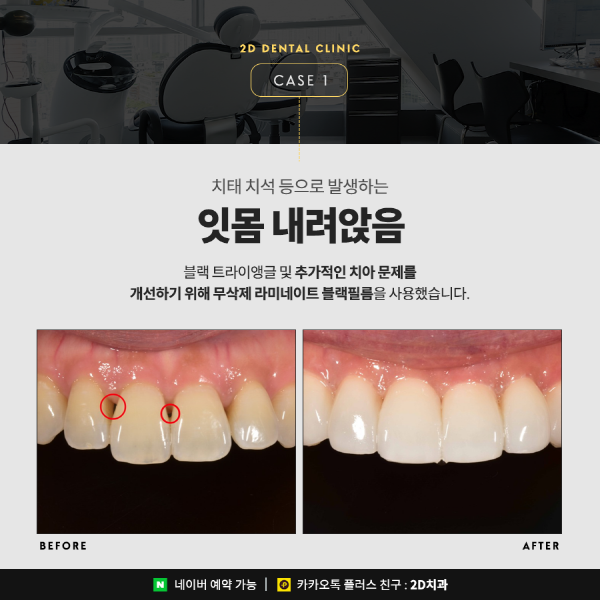 앞니깨짐, 치아변색 앞니고민 해결사! <세라필름 &middot; 블랙필름> 관련 이미지 4