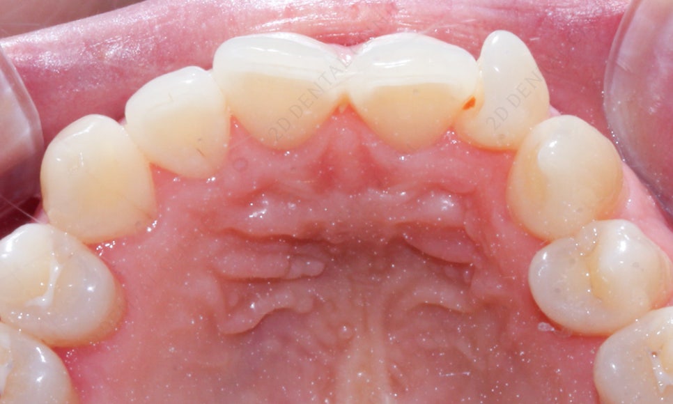 덧니치아 앞니교정 4개월 교정 완료! by. 투디치과(2D치과) 관련 이미지 4