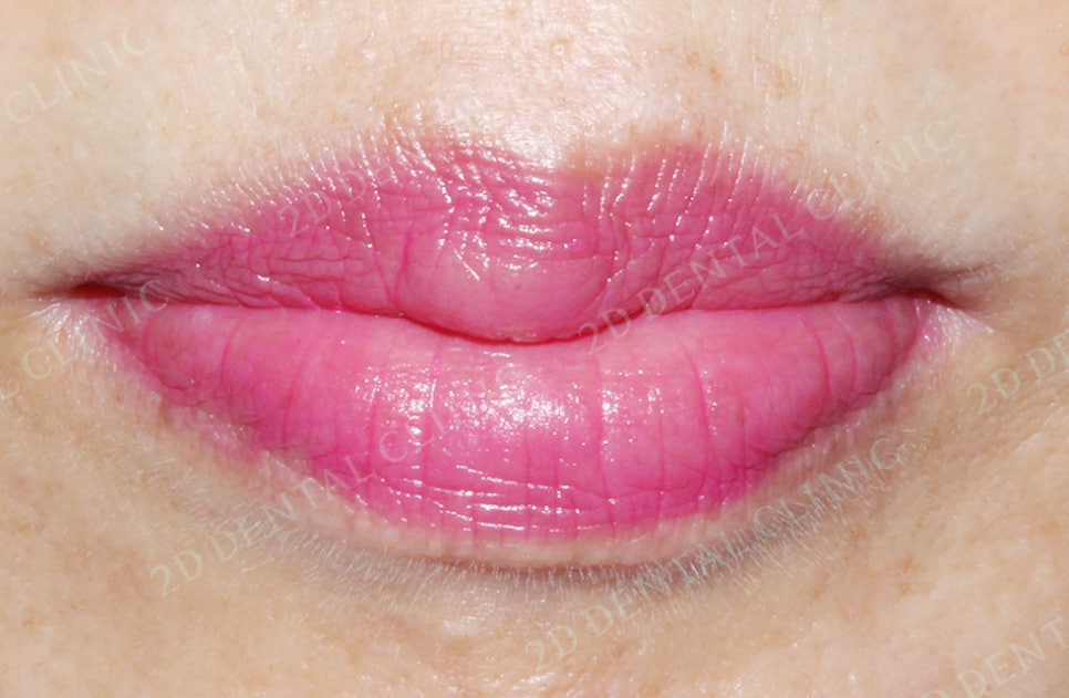 2D치과(투디치과) 교정일기 ㅣ 잇몸질환 예방되는 치아교정(feat.어머님교정) 관련 이미지 6