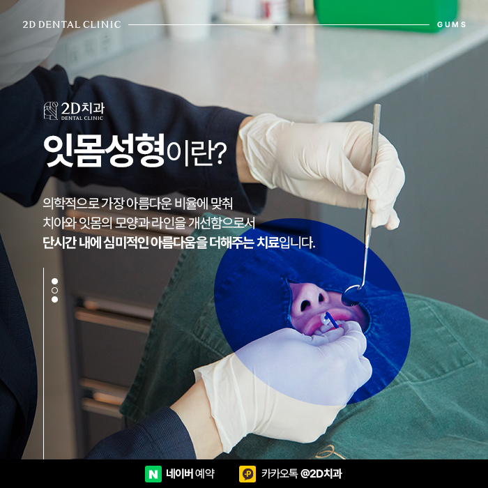 치아관리만큼 중요한 잇몸관리, 잇몸염증, 잇몸퇴축 예방하는 방법, 신논현 잇몸성형 관련 이미지 5
