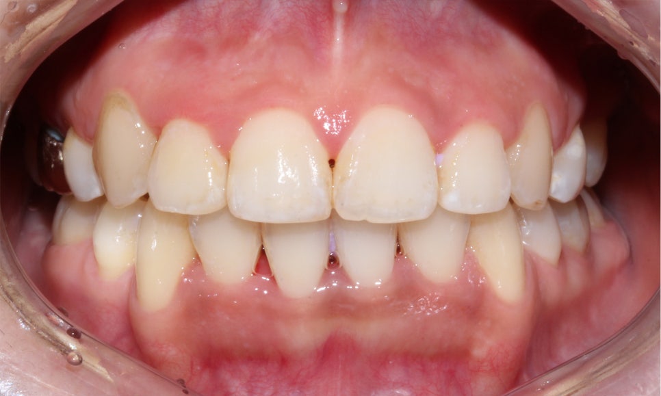 crowding 송곳니덧니 세라믹교정 방법 관련 이미지 9