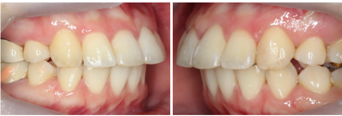 토끼앞니교정 부분교정으로 단기완성 관련 이미지 10