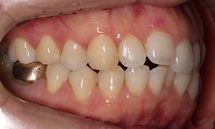 앞니틀어짐 부분교정 완성 후기 관련 이미지 4