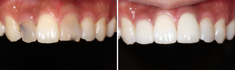 무삭제블랙필름 실제 후기 관련 이미지 5