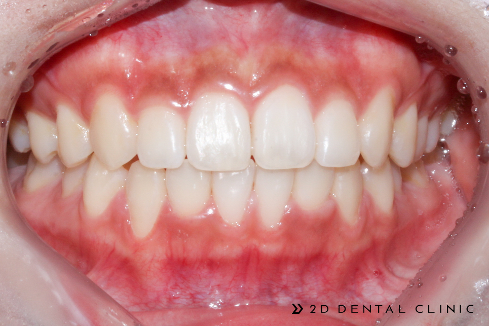 케이스로 확인하는 토끼이빨, 교정전문 2D치과 관련 이미지 8