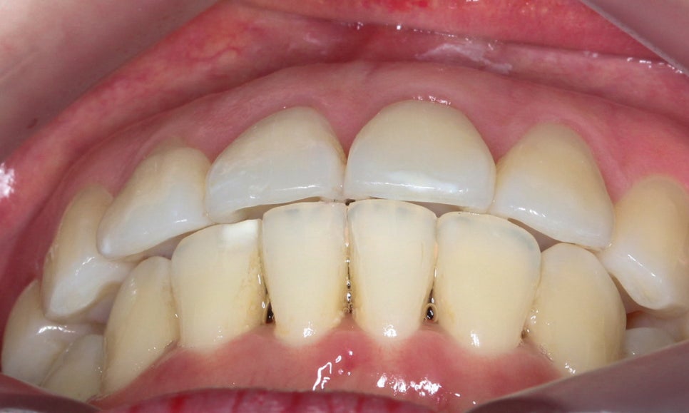 입툭튀 교정 신논현역치과 전체교정으로 관련 이미지 9