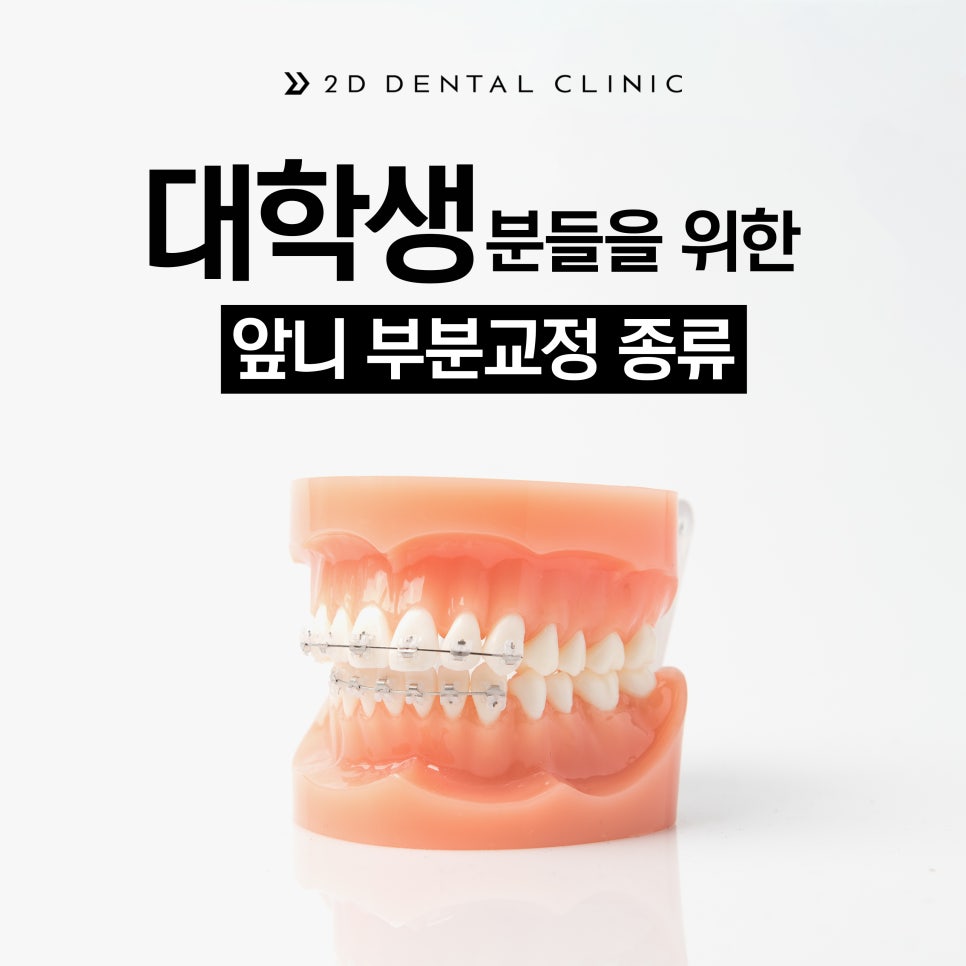 방학기간 동안 대학생을 위한 앞니 부분교정 종류 관련 이미지 2