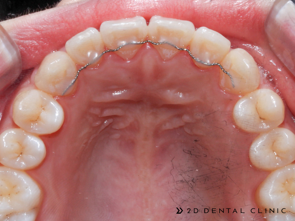 케이스로 확인하는 토끼이빨, 교정전문 2D치과 관련 이미지 10