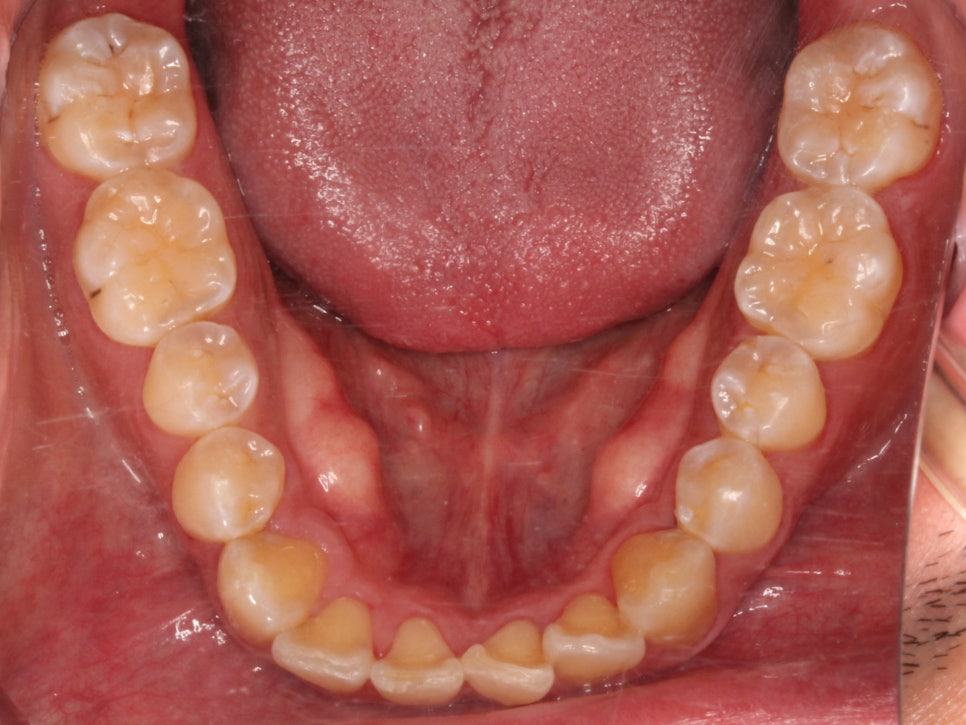 앞니 덧니 고민, 부분 설측 교정으로 해결한 사례 관련 이미지 4
