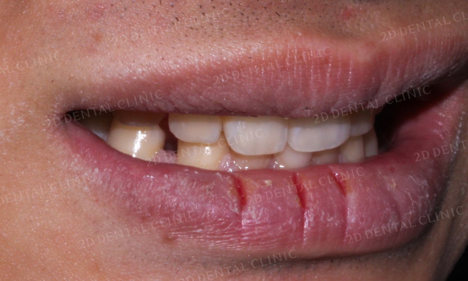 [앞니교정] 벌어진 앞니, 부분교정으로 앞니교정하기! by.2D치과(투디치과) 관련 이미지 12