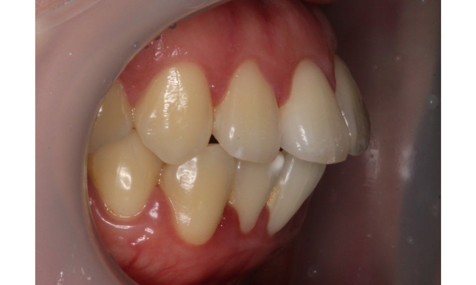 입툭튀 교정 신논현역치과 전체교정으로 관련 이미지 3