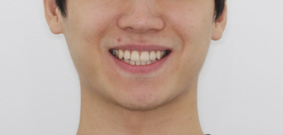 부분교정으로 삐뚤어진 앞니 예뻐지는 방법 관련 이미지 22