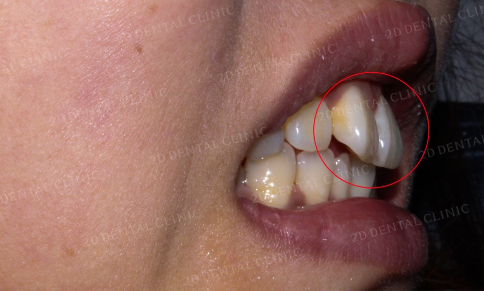 [2D교정] 나비치아, 앞니교정 설측교정으로 빠르게 하는 방법! by.2D치과(투디치과) 관련 이미지 4