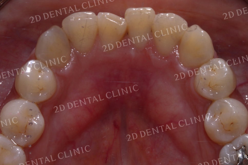 반대교합으로 물리는 치아를 바른 교합으로 교정하기! by.투디치과(2D치과) 관련 이미지 16