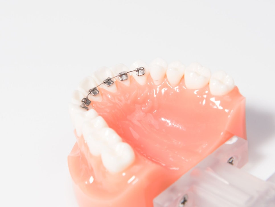 강남역치과[투디치과]투디교정/앞니교정 관련 이미지 1