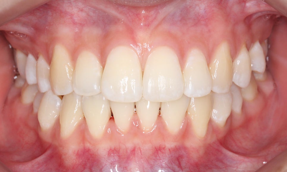 신논현치과 자가결찰브라켓 장점 관련 이미지 9