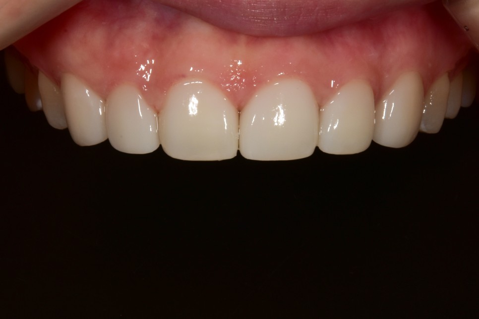 [투디치과] 블랙필름(비스포크) 치료의 다양한 사례 관련 이미지 17