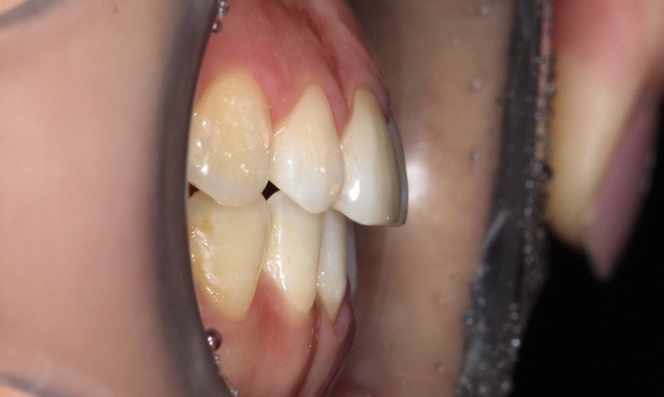 절단교합 클리피씨 교정 방법 관련 이미지 10