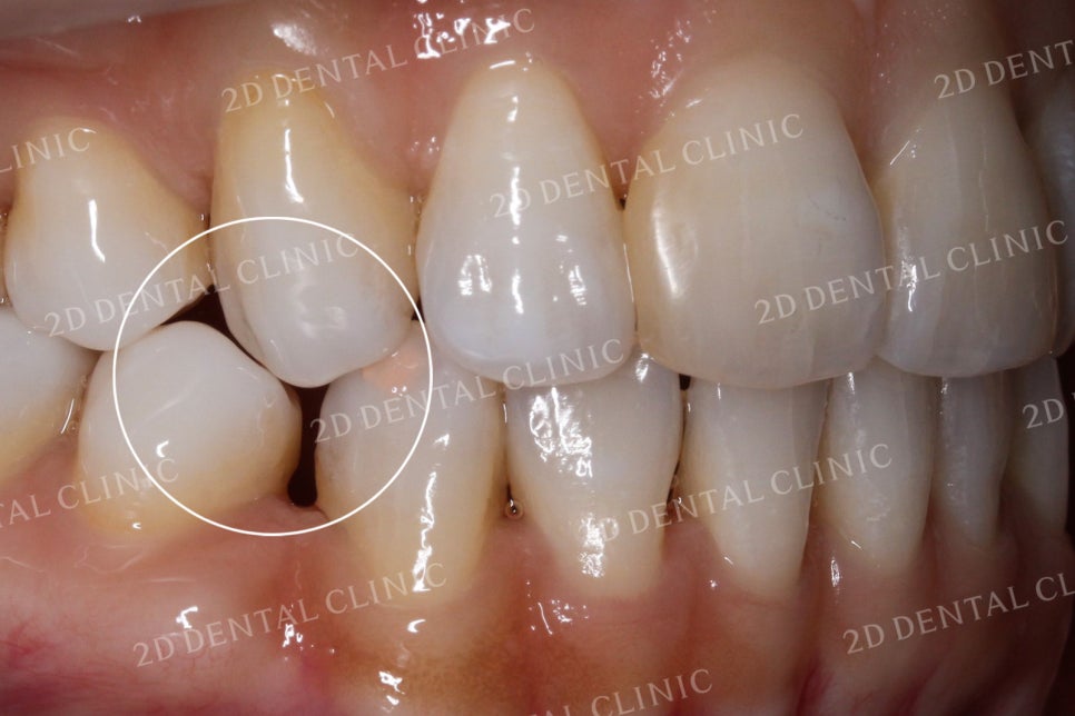 치아틈새를 완벽하게 메꾸자! 블랙트라이앵글 쎄라필름으로 완전 삭제! by.투디치과(2D치과) 관련 이미지 4