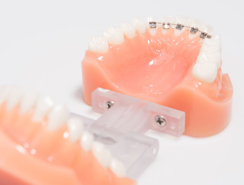 와,앞니 부분교정?!이라고?! 관련 이미지 3