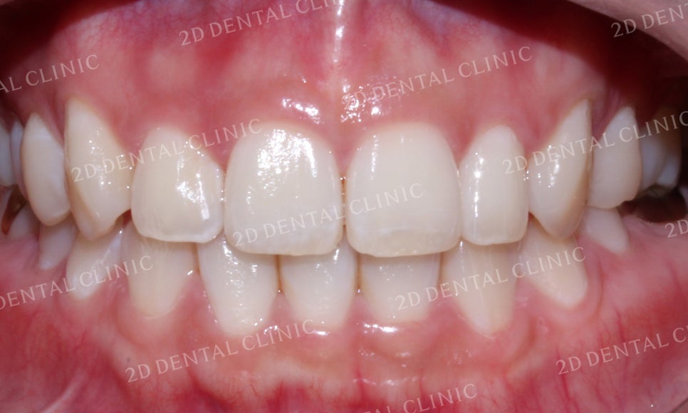 나비치아교정, 부분교정으로 나비치아 탈출하기! by.투디치과(2D치과) 관련 이미지 15