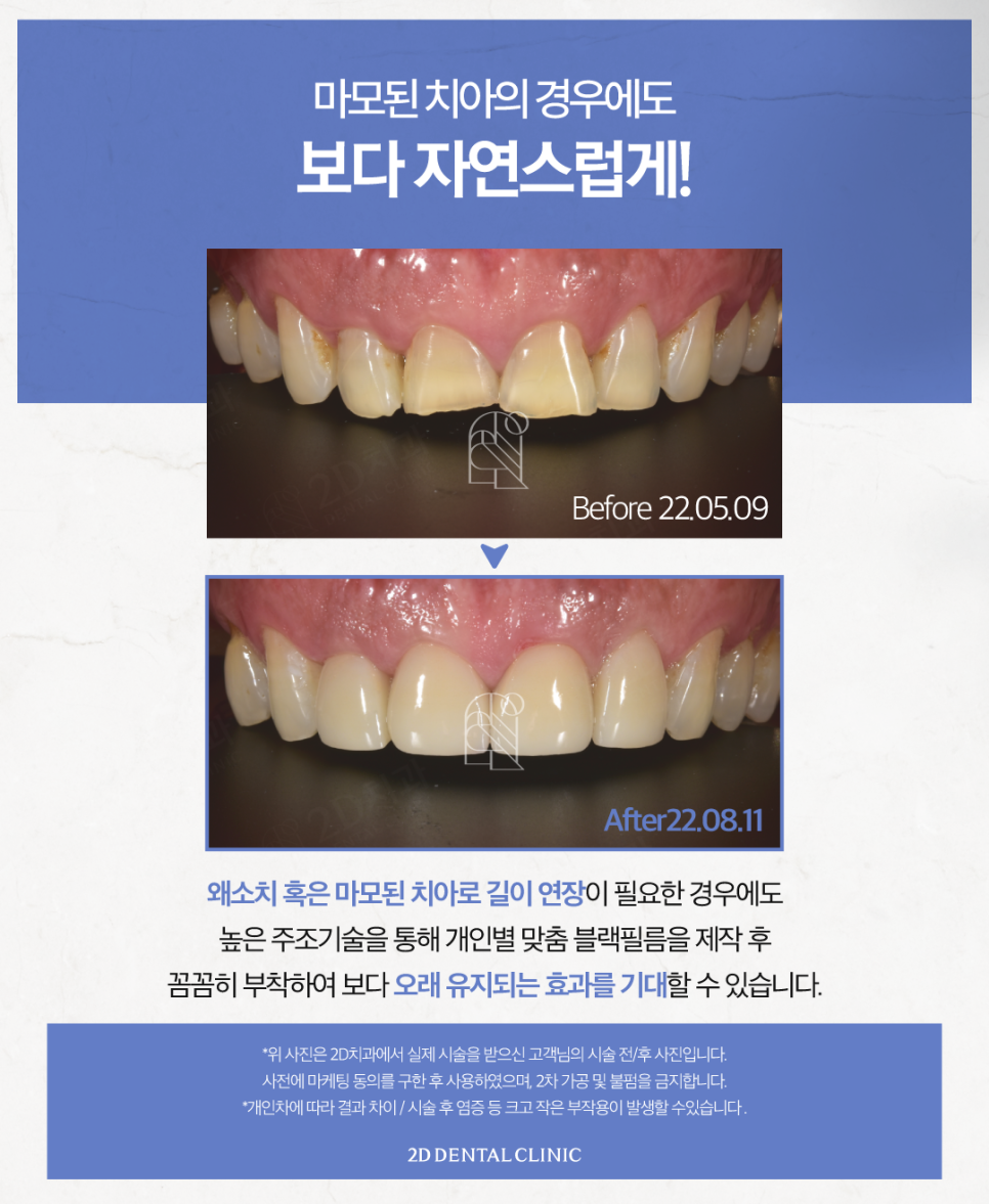 무삭제라미네이트후기 심미보철 나에게 적합한 방식을 찾아보세요 관련 이미지 6