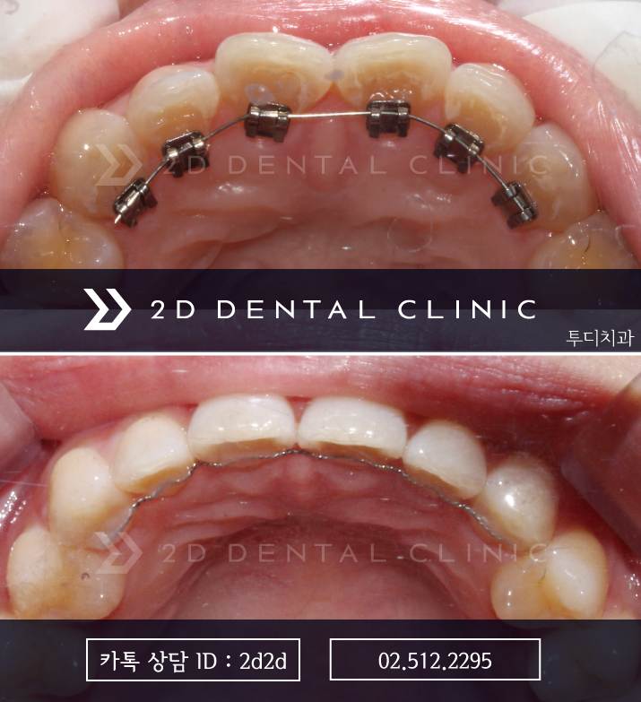 앞니 부분교정, 나의 경우에도 가능할까? 전후 사진 비교 관련 이미지 4