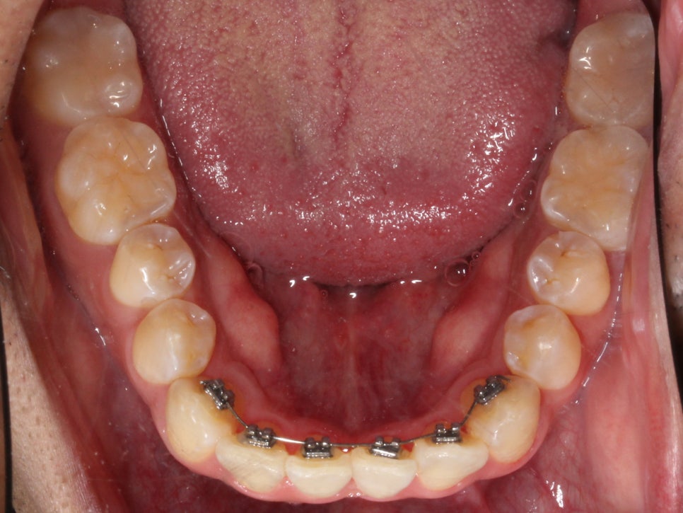 앞니 덧니 고민, 부분 설측 교정으로 해결한 사례 관련 이미지 9