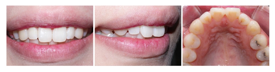 2D치과(투디치과)교정일기 ㅣ 연예인이 많이하는 2D교정 토끼이빨 case 관련 이미지 2