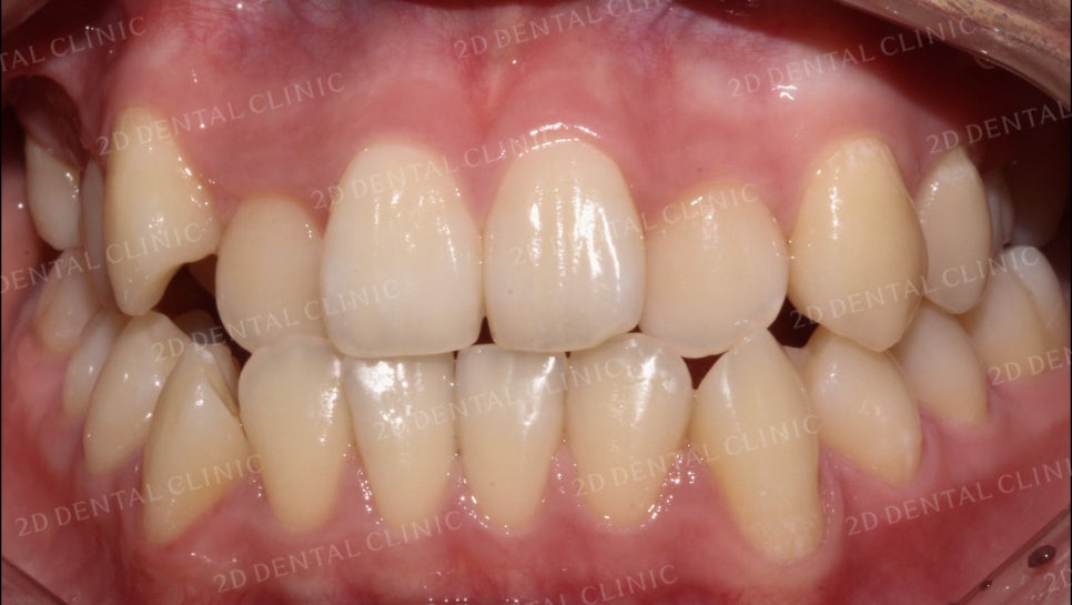 덧니치아교정, 클리피씨 전체교정으로 완벽하게! by.투디치과(2D치과) 관련 이미지 2