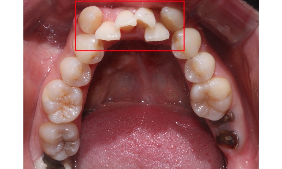 crowding 송곳니덧니 세라믹교정 방법 관련 이미지 8