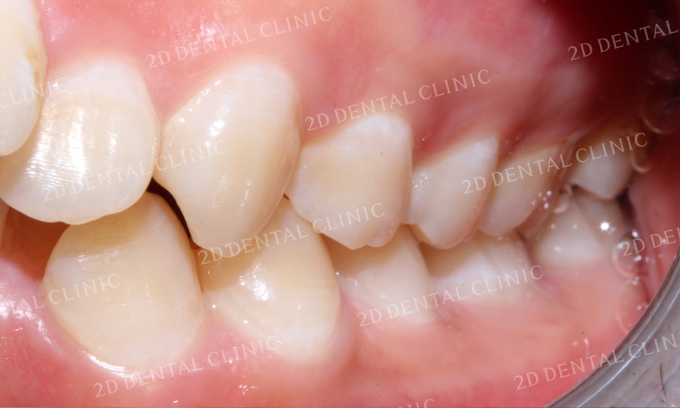 돌출앞니 교정, 튀어나온 입을 넣어보자! by.투디치과(2D치과) 관련 이미지 7