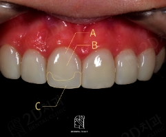 앞니왜소치 치아깨짐 무삭제라미네이트 블랙필름 관련 이미지 9