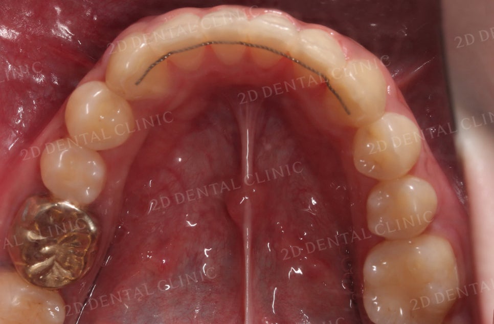 [앞니교정] 토끼앞니교정, 클리피씨 교정으로 완벽하게! by.투디치과(2D치과) 관련 이미지 19