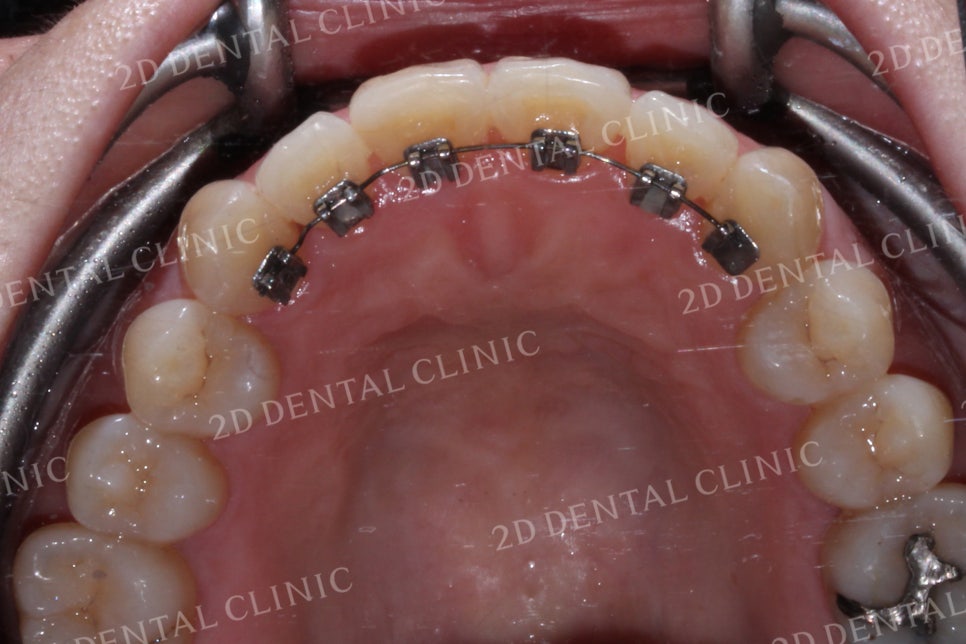 반대교합으로 물리는 치아를 바른 교합으로 교정하기! by.투디치과(2D치과) 관련 이미지 15