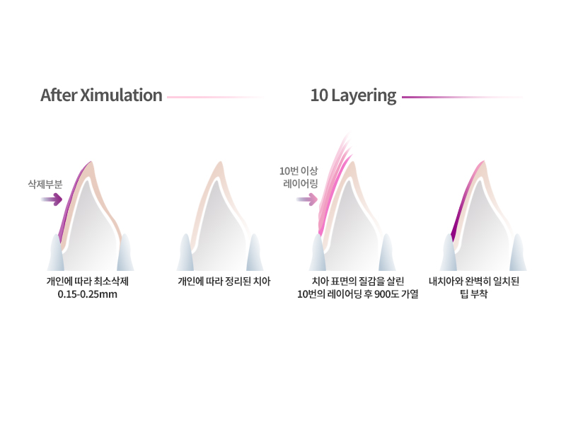 평생 소장! 앞니보철은 자연스러운 2D치과(투디치과) BLINX(블링스)로! 관련 이미지 6