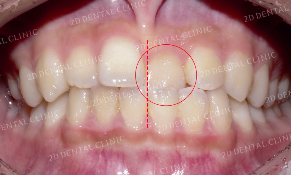 반대교합 치아교정, 앞니를 가지런하게! by.투디치과(2D치과) 관련 이미지 4