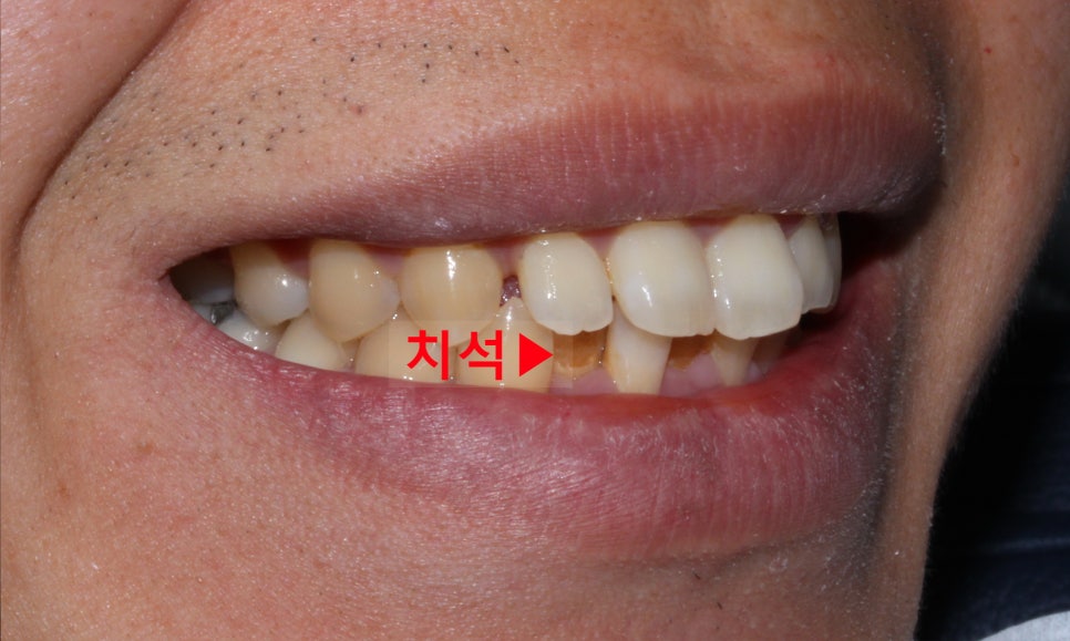 뻐드렁니 교정, 강남역치과에서 앞니 부분 교정한 후기! 관련 이미지 4