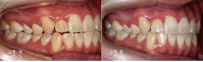 앞니 덧니 고민, 부분 설측 교정으로 해결한 사례 관련 이미지 18