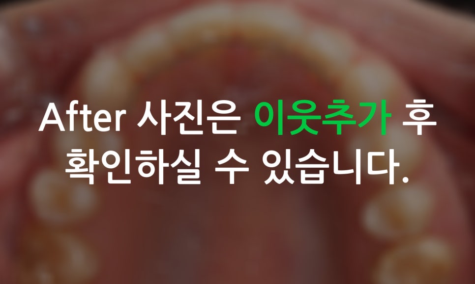 2D치과(투디치과)가 소개하는 토끼앞니 2D교정방법! 관련 이미지 9