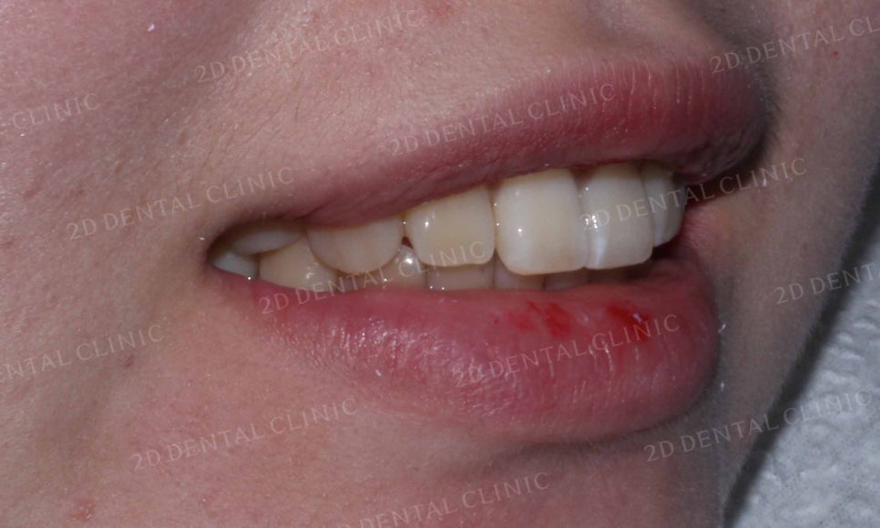 강남역 치과에서 앞니부분 설측 2D(투디)교정으로 토끼앞니 탈출한 후기 관련 이미지 13