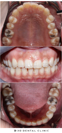 비발치교정, 발치 없이 교정하기! 강남 2D치과 관련 이미지 4