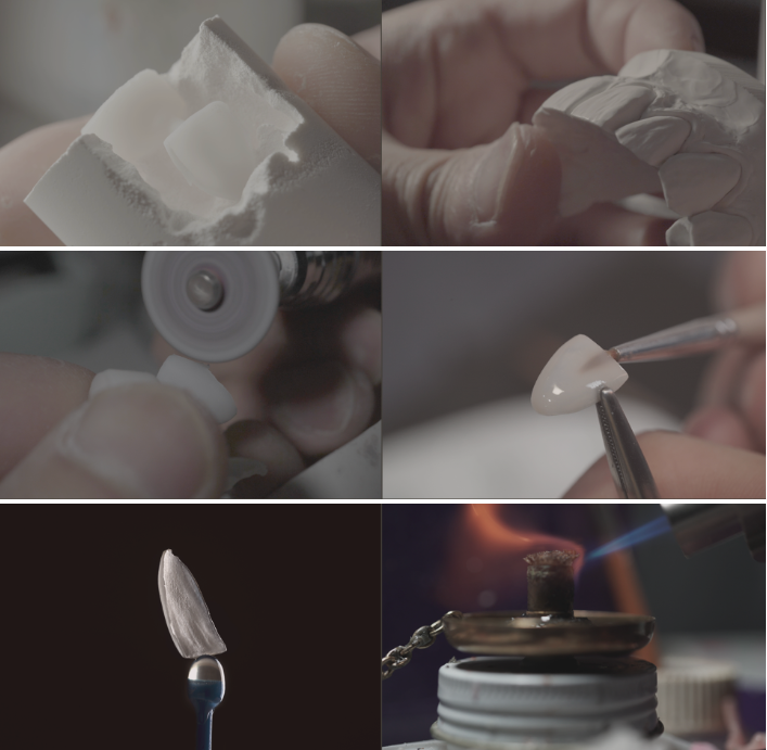 앞니깨짐 앞치아치료는 무삭제라미네이트 블랙필름 관련 이미지 8