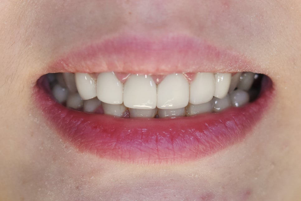 연예인라미네이트 무삭제로 잘하는 2D치과 관련 이미지 12