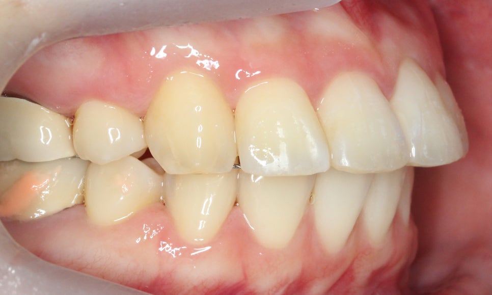 대치동치과 입툭튀 집어넣는 교정 관련 이미지 11