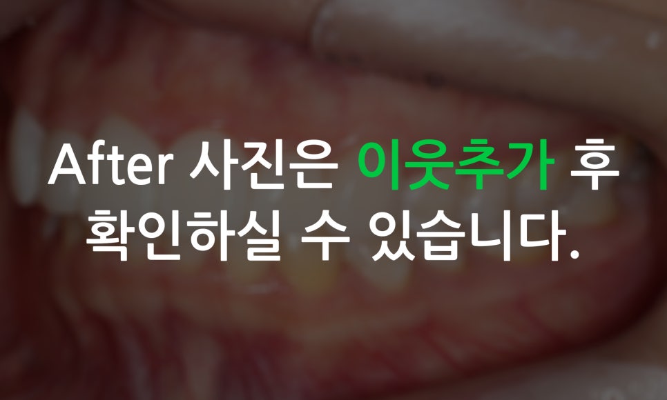 송곳니덧니 교정과 왜소치 세라필름을 한번에! 관련 이미지 11